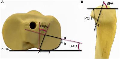 Biomechanics and finite element analysis comparing posterior T-plates with LCP for fixation of posterolateral tibial plate fractures